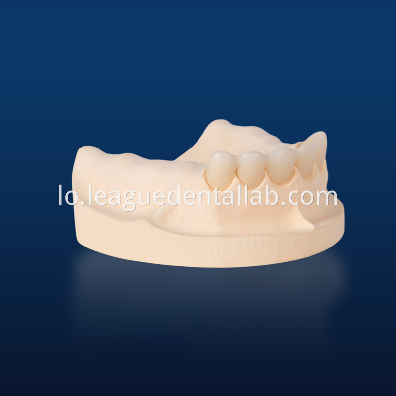 PFZ,Porcelain Fused to Zirconia,Zirconia Layered, Zirconia Veneered